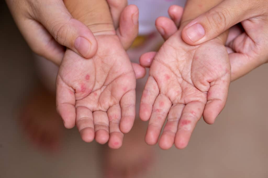 Hand Fuß Mund Krankheit