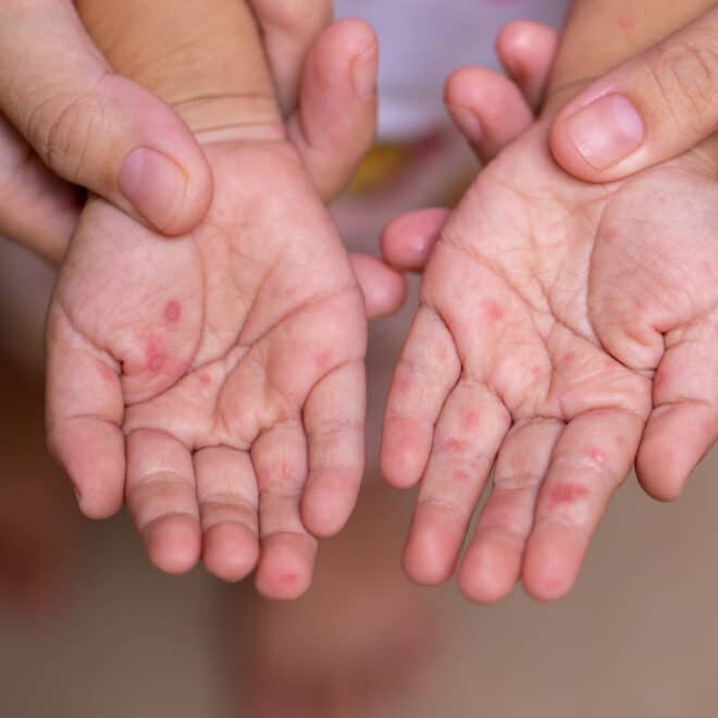 Hand-Fuß-Mund Krankheit: Von der Infektion bis zur Behandlung