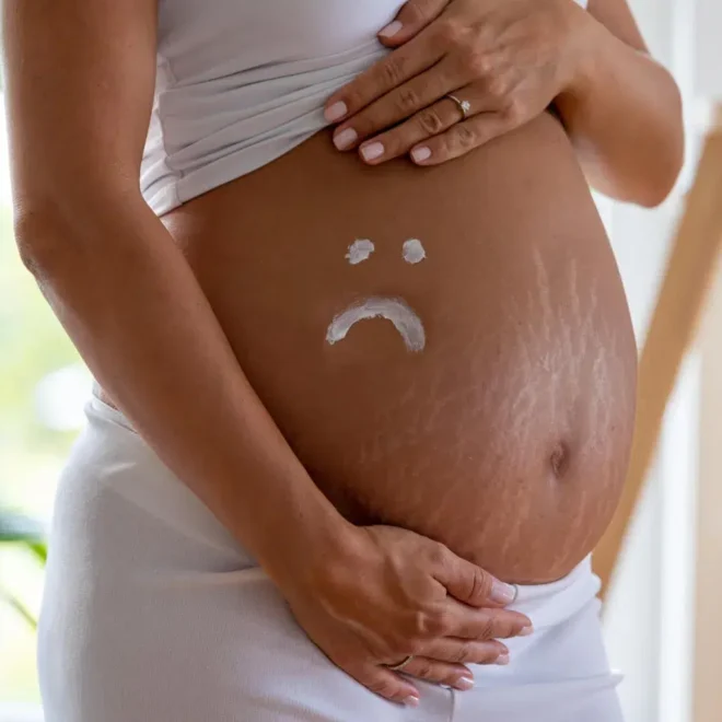 Dehnungsstreifen in der Schwangerschaft – wie kann man vorbeugen?